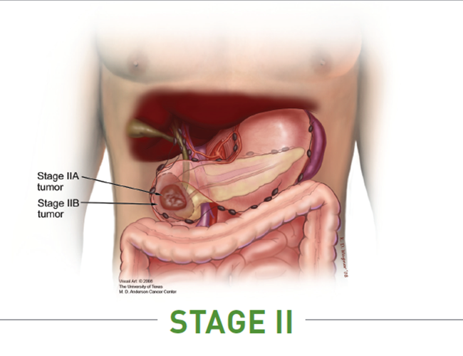 PS17_KnowYourPancreas_Stage2PC